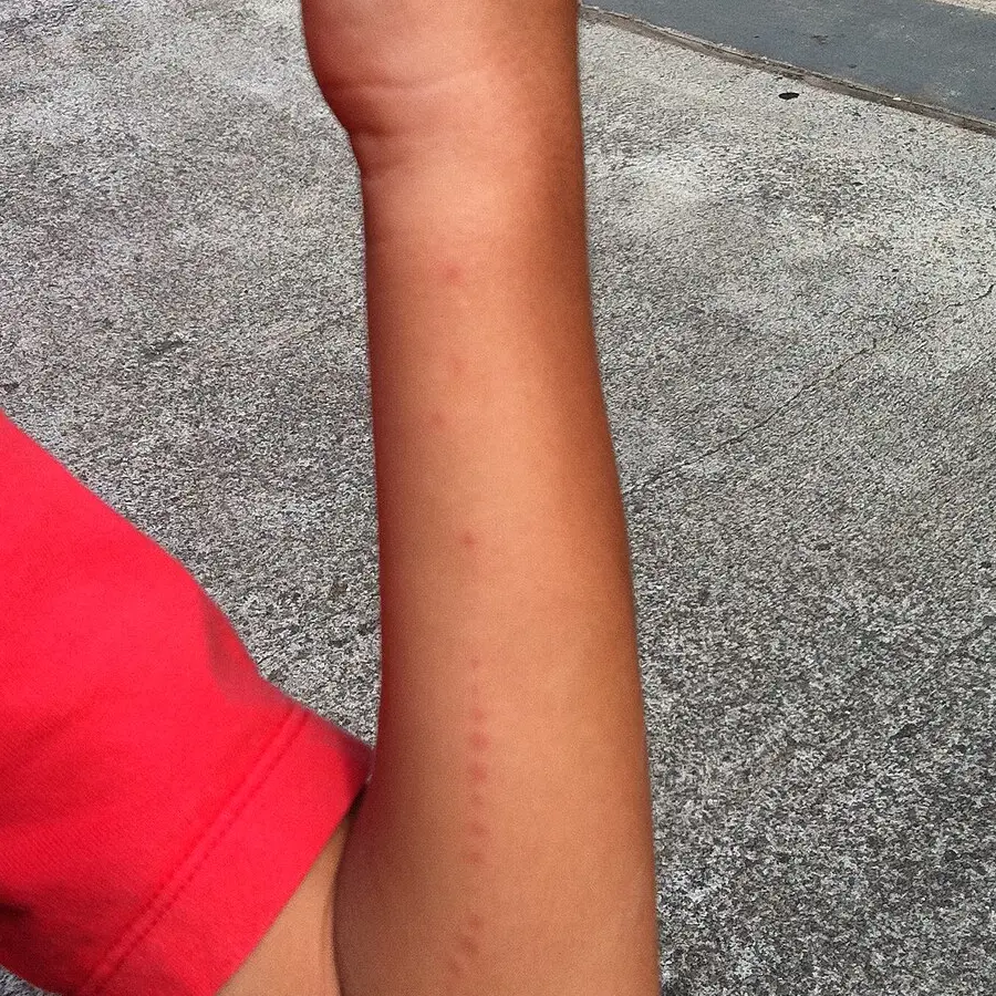 Man o’ war sting on a child’s forearm — a line of small red beads along the arm