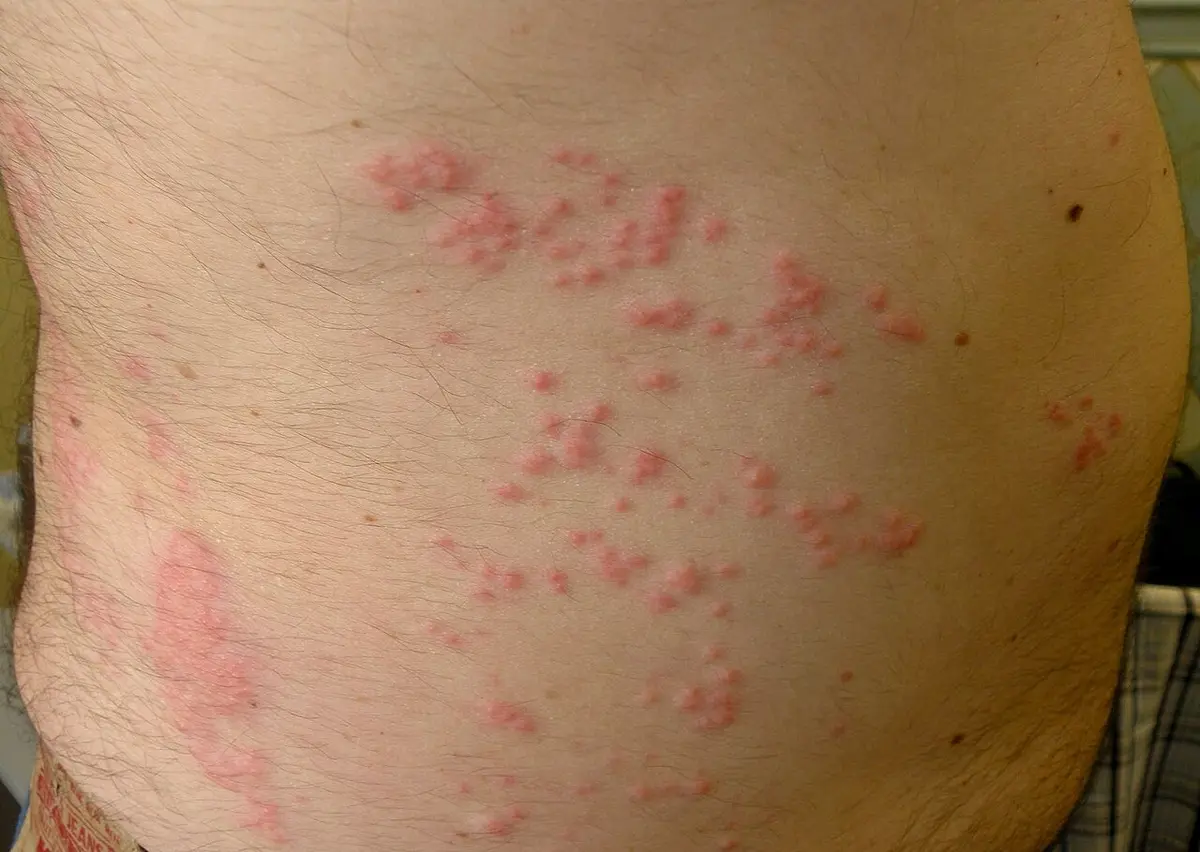 Jellyfish sting rash on the side of the torso — clusters of small pink bumps
