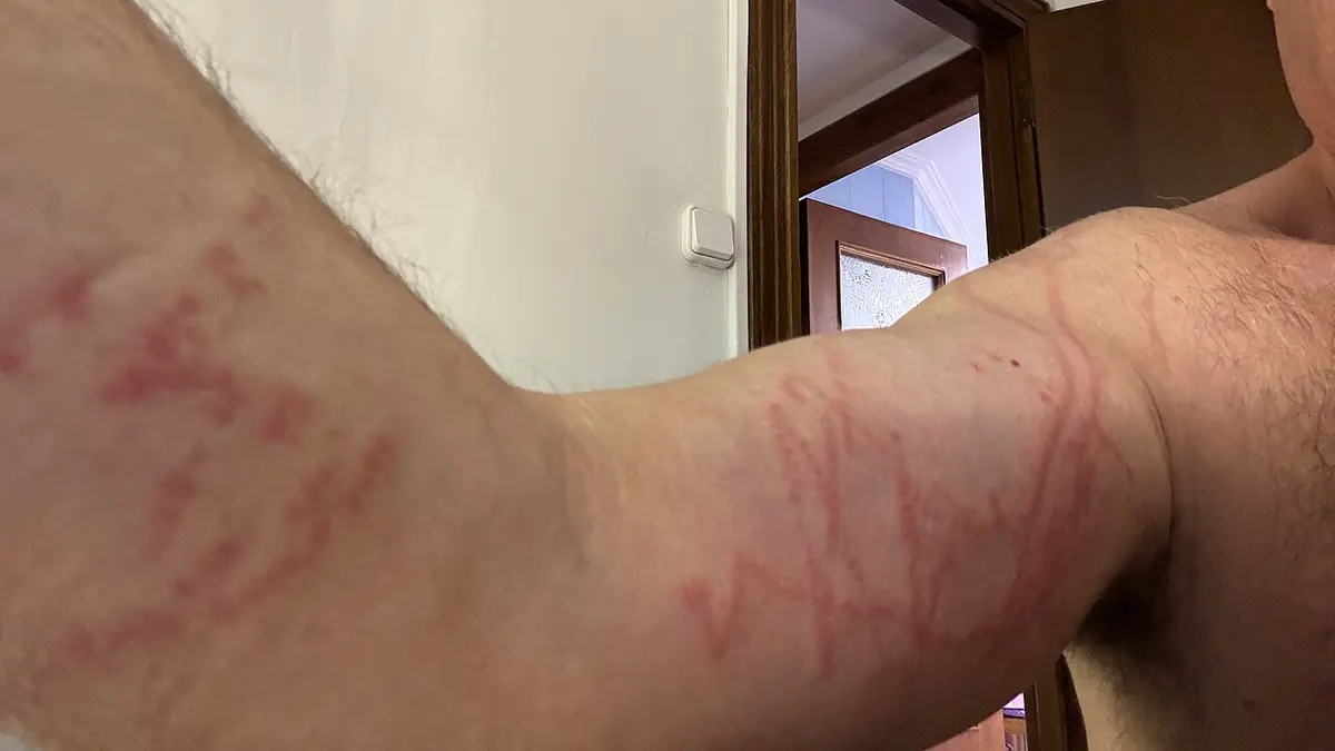 Portuguese man o’ war sting marks on an arm and shoulder — thin, winding red lines